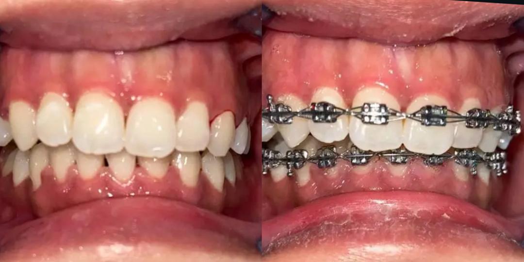 Rawatan aligner dan braces